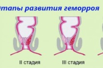 хемороиди