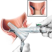 хемороидектомия