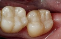 предните зъби