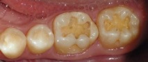 предните зъби