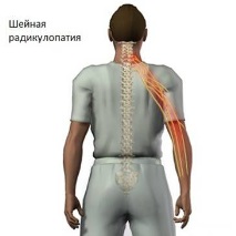 Прищипани шийни прешлени симптоми и лечение