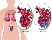 Симптомите пневмония
