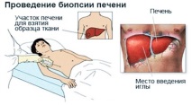 лечение дроб