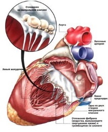 ревматични сърдечни заболявания