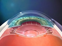 Цени за имплантация на ВОЛ за подмяна на очната леща с вътреочна леща,  консултация с офталмолог през