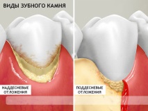 зъбната