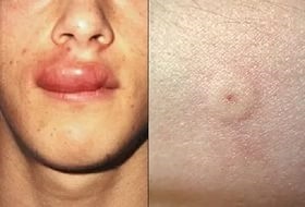 Alergii la intepaturi de insecte simptomele și tratamentele sale (de insecte) Alergii la intepaturi de insecte simptomele și tratamentele sale