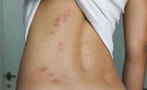 Alergia la insecte înțeapă simptomele sale si tratamente (mușcăturile) Alergii la intepaturi de insecte simptomele și tratamentele sale