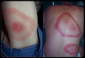 Alergia la insecte înțeapă simptome și metode de tratament sale (simptomelor) Alergii la intepaturi de insecte simptomele și tratamentele sale