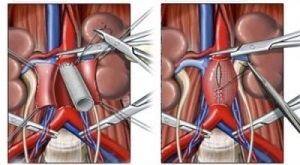 Abdominale simptome aortic anevrism si tratament (anevrism) anevrism aortic simptome abdominale si tratament