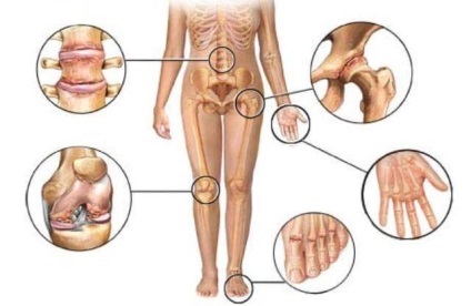 Artrita 6 pași pentru a atenua efectele acesteia (factorii care pot) Artrita 6 pasi pentru a atenua consecințele sale
