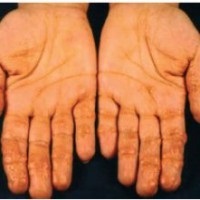 perleches aftoasă, herpes, boala Fordyce (boala) Boli perleches buzelor, herpes, boala Fordyce