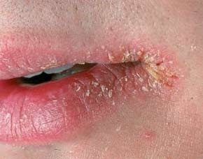 perleches aftoasă, herpes, boala Fordyce (boala) Boli perleches buzelor, herpes, boala Fordyce