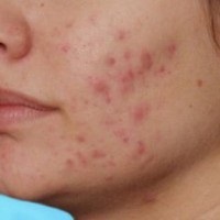 perleches aftoasă, herpes, boala Fordyce (boala) Boli perleches buzelor, herpes, boala Fordyce