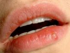 perleches aftoasă, herpes, boala Fordyce (perleches) Boli perleches buzelor, herpes, boala Fordyce