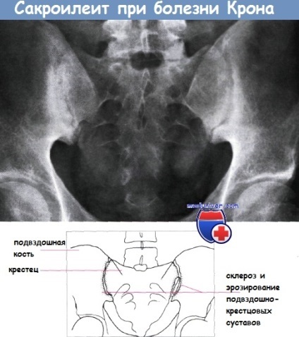 Boala Crohn (o boală) Boala Crohn