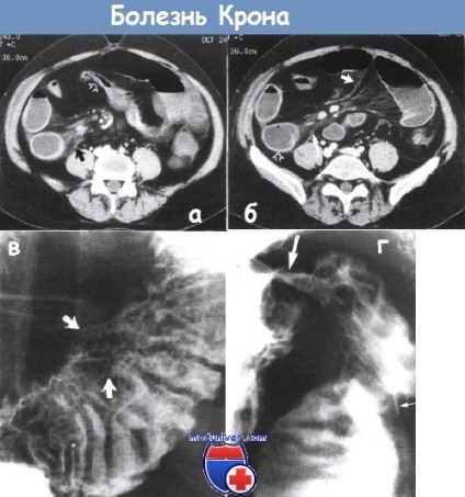 Boala Crohn