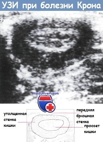 Boala lui Crohn (segmentul terminal de ileal) Boala Crohn