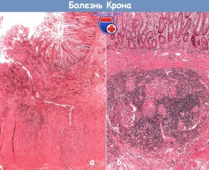 Boala Crohn (segmentul ileon) Boala Crohn