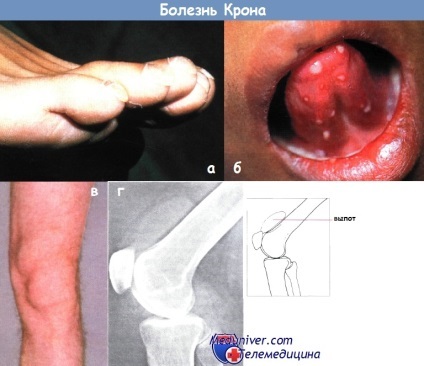 Boala Crohn (săgeata toroane inflamatorii) Boala Crohn