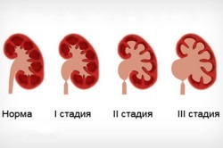 Temperatura Hurt rinichi și ceea ce a cauzat apariția simptomelor (temperatură) Temperatura doare rinichiul și ceea ce a cauzat apariția simptomelor