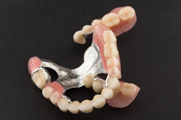 proteza Clasp pe maxilarul inferior pe agrafa, castele si coroane - preț, recenzii, fotografii (costul protezei parțiale la nivelul maxilarului inferior) proteza Clasp pe maxilarul inferior pe agrafa, castele si coroane - preț, recenzii, fotografii
