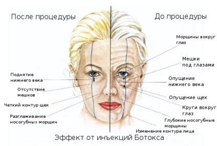 Ce Dysport mai bine sau Botox - recenzii ale clientilor, iar diferența dintre medicamente (comentarii) Ce Dysport mai bine sau Botox - recenzii ale clientilor, iar diferenta dintre droguri