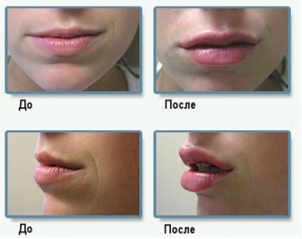 Ce Dysport mai bine sau Botox - recenzii ale clientilor, iar diferența dintre medicamente (comentarii) Ce Dysport mai bine sau Botox - recenzii ale clientilor, iar diferenta dintre droguri