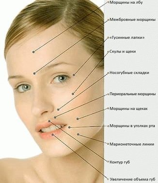 Ce Dysport mai bine sau Botox - recenzii ale clientilor, iar diferența dintre medicamente (comentarii) Ce Dysport mai bine sau Botox - recenzii ale clientilor, iar diferenta dintre droguri
