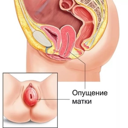 Ce este prolaps uterin (prolapsul) Ce este prolaps uterin