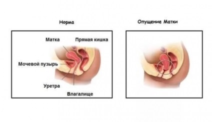 Ce este prolaps uterin (a) Ce este prolaps uterin