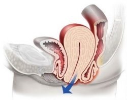 Ce este prolaps uterin (uter înseamnă offset) Ce este prolaps uterin