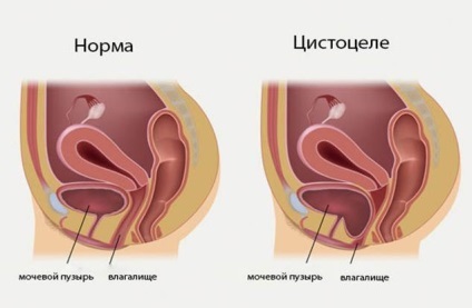 Ce este prolaps uterin (a) Ce este prolaps uterin