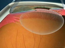 Corpul ciliar (ciliar), ceea ce este, structura, funcția corpului ciliar (structura) Corpul ciliar (ciliar), ceea ce este, structura, funcția corpului ciliar