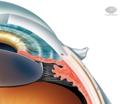Corpul ciliar (ciliar), ceea ce este, structura, funcția corpului ciliar (corpul) Corpul ciliar (ciliar), ceea ce este, structura, funcția corpului ciliar
