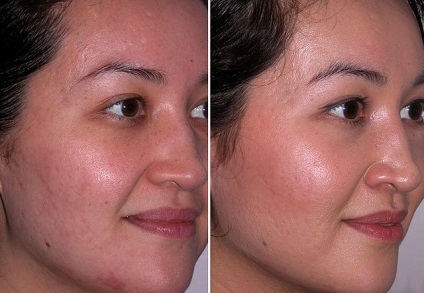 raspunsuri faciale Dermabraziunea, tipuri de proceduri, înainte și după fotografii, video (dermabraziune) raspunsuri faciale Dermabraziunea, tipuri de proceduri, înainte și după fotografii, video