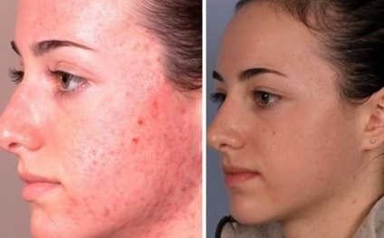 raspunsuri faciale Dermabraziunea, tipuri de proceduri, înainte și după fotografii, video (dermabraziune) raspunsuri faciale Dermabraziunea, tipuri de proceduri, înainte și după fotografii, video