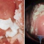 Drojdie ciuperca în tratamentul femeilor, simptomele, fotografia (soldul microflorei vaginale) drojdie infecție la femeile tratate, simptomele, fotografii