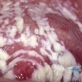 Drojdie infecție la femei simptome de tratament fotografie (drojdie) drojdie infecție la femeile tratate, simptomele, fotografii