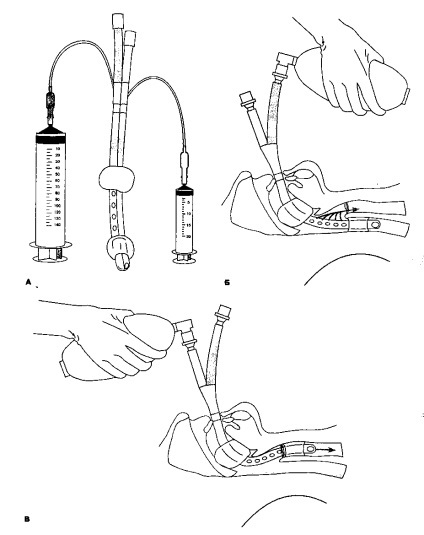 Tuburi endotraheale (FIBEROPTIC bronhoscop bronhoscopie) tuburi endotraheale