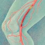 Flebologia Moscova, tratamentul varicelor în centrul Moscova mupf angio înregistrare clinici Flebologie (Moscova) Flebologia Moscova, tratamentul varicelor în centrul Moscova mupf angio intrare clinici flebologie