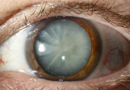 Funcția lentilă (ochiul optic de lentile) funcţia de lentile