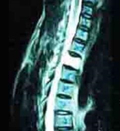 spinal hemangiom - ceea ce este modul de a trata hemangiomul spinarii (a) spinal hemangiom - ceea ce este modul de a trata hemangioame spinării