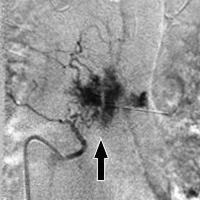 spinal hemangiom - ceea ce este modul de a trata hemangiomul spinarii (hemangiom) spinal hemangiom - ceea ce este modul de a trata hemangioame spinării