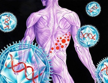 Herpes zoster (se toarna cana de apa fierbinte) herpes zoster