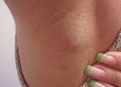 Hidradenitis - tratament (tratament) Hidradenitis - tratament