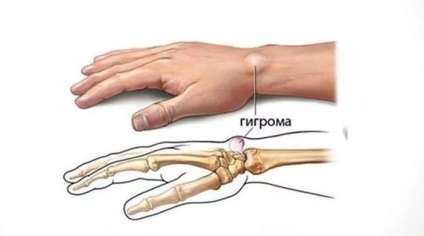 Higroma ce este, simptomele sale și metode de tratament (simptomelor) Higroma ce este, simptomele și tratamentele