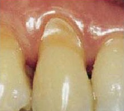 hipersensibilitatii dentare - cauze, simptome, diagnostic si tratament (cauza) hipersensibilitatii dentare - cauze, simptome, diagnostic și tratament