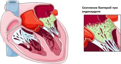 Rotten cauze dinți, tratamentul și prevenirea