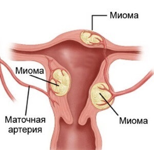 -Interstițiale subseros uterine simptome fibroid si tratament (fibrom uterin interstițială) Intercalărilor subseros simptome fibrom uterin si tratament